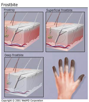 Bad Forstbite Frostbite | BaroMedical Canada